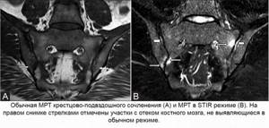 MRI of the sacroiliac joint in STIR mode