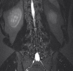MRI of the sacroiliac joints