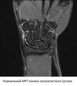 MRI of the wrist joint is normal