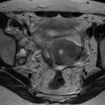 What does a pelvic MRI show?