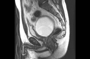 MRI of the pelvis in men