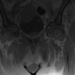 MRI of the bladder, which shows