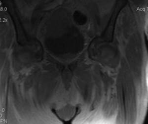 MRI of the bladder, which shows