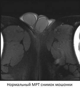 MRI of the scrotum is normal
