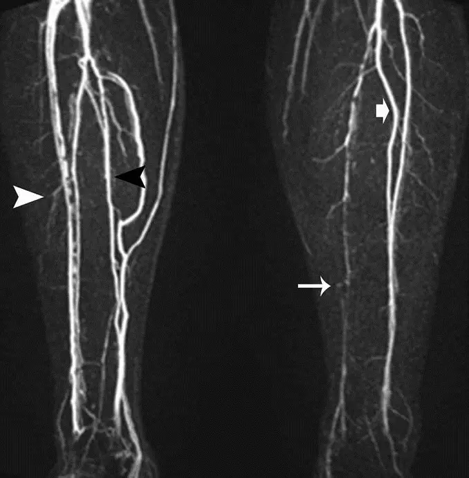 MRI of lower extremities with contrast agent