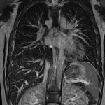 MRI of the chest
