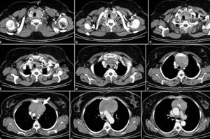 MRI of the mediastinum and lungs