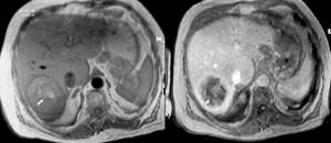 MRI of the liver without contrast and after gadolinium administration