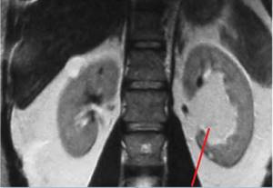 MRI kidney sinus tumor