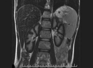 Kidney MRI is normal