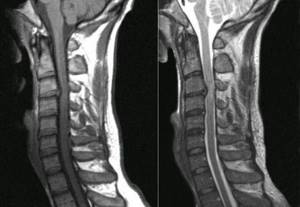 MRI of the spine
