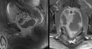 Prostate MRI shows abscess