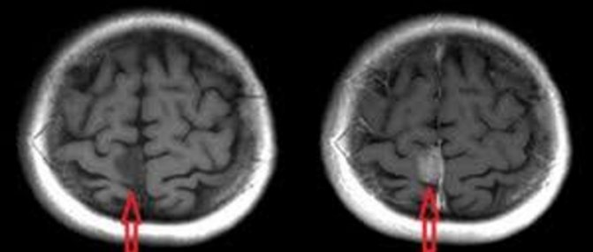 MRI with and without contrast