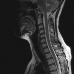MRI of the cervical spine
