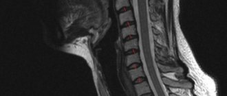 MRI of the cervical spine