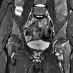 MRI of the hip joint, which shows