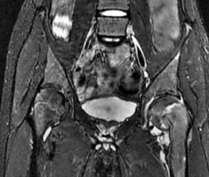 MRI of the hip joint, which shows