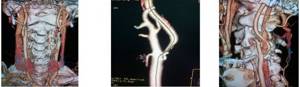 MSCT of brachiocephalic arteries
