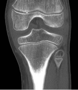 MSCT of the knee joint (coronal projection)
