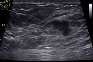 Ultrasound image shows fibroadenoma
