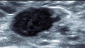 The ultrasound image shows a neoplasm characterized by hypoechogenicity