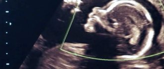 The embryo is not visible on ultrasound