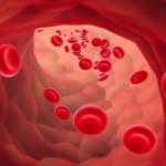 Low hemoglobin in oncology