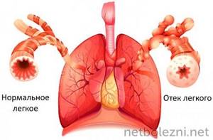 Normal lung and edema