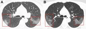 Foci of lung damage in COVID-19
