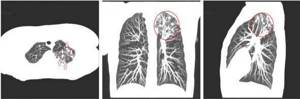 Focal changes on CT scan of the lungs, suspicious for tuberculous lesions (highlighted in red)