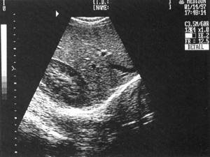 One of the options for an echogram of normal liver parenchyma