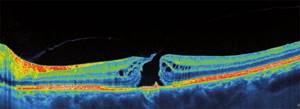 OCT of the eye for macular hole