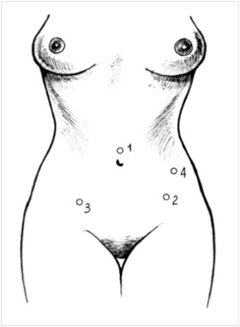 Operations on the fallopian tubes, trocar insertion points