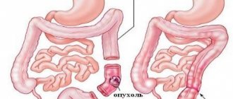 Surgery for sigmoid colon cancer