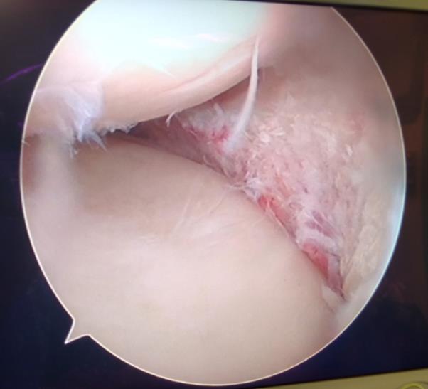 meniscus removal surgery