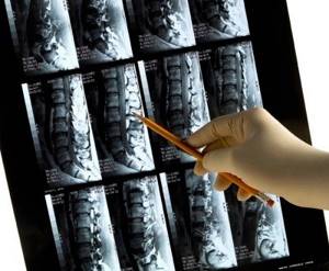 Description of MRI of the spine