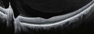 Optical coherence tomography of the eye