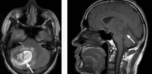 Brain tumor on MRI image