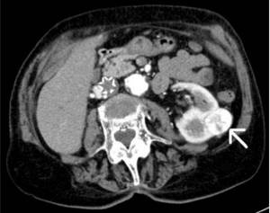 A tumor of the left kidney identified on a CT scan of the urinary system with contrast (indicated by an arrow)
