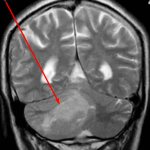 Cerebellar tumor on MRI