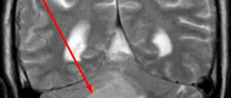 Cerebellar tumor on MRI