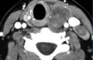 Parathyroid tumor on CT scan
