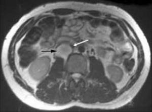 Kidney tumor on MRI