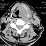 Thyroid tumor on computed tomography