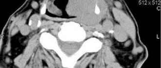 Опухоль щитовидной железы на компьютерной томографии