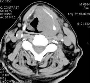 Thyroid tumor on computed tomography