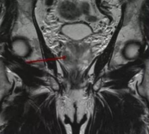 Tumor node in the right lobe of the prostate on an MRI photo