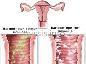 Основные разновидности вагинита