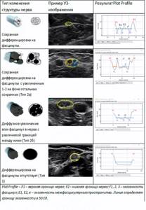 Main types of changes in the sonographic structure of the nerve