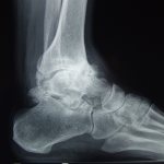 Osteoarthritis of the ankle joint